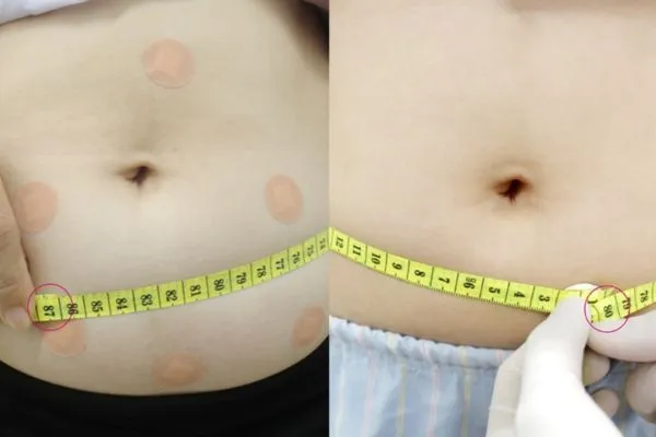 Cấy chỉ giảo béo trong Y Học Cổ Truyền
